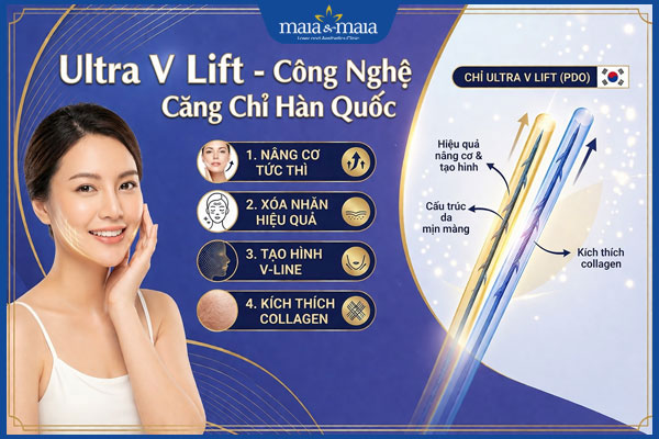 căng chỉ ultra v lift