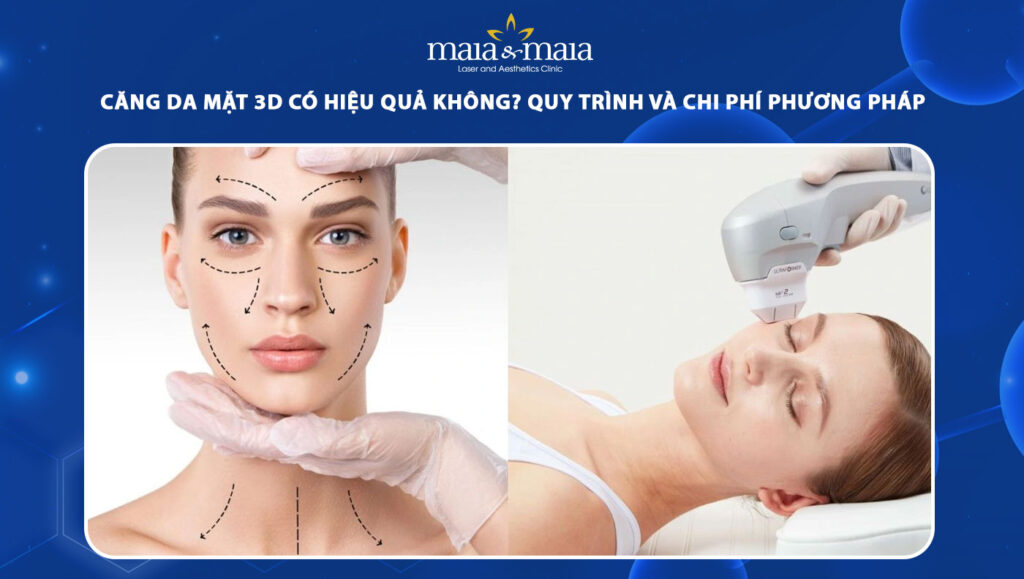 Căng da mặt 3D hiệu quả không? Quy trình & chi phí thực hiện 1 căng da mặt 3D
