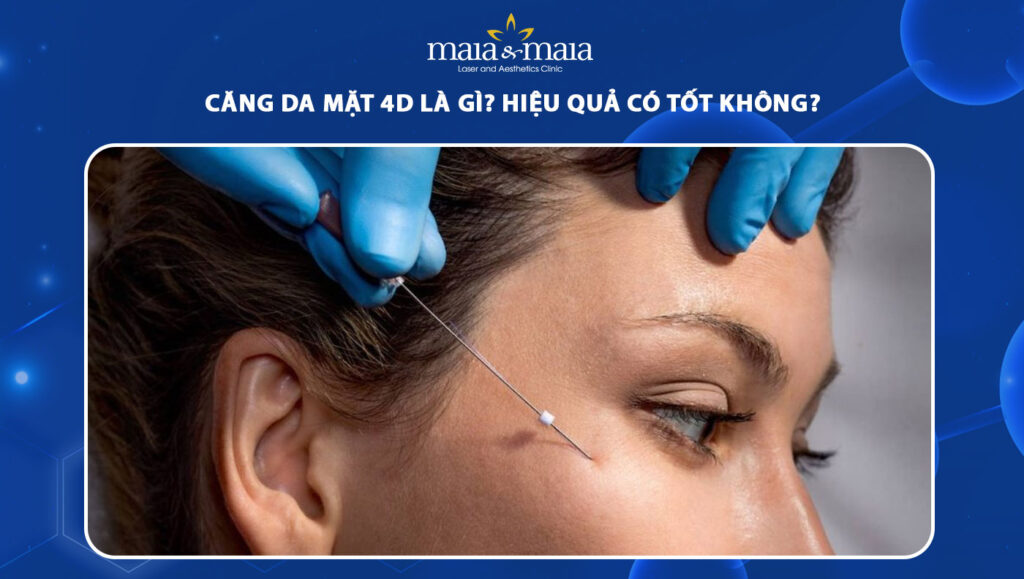 căng da mặt 4D