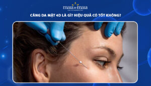 căng da mặt 4D