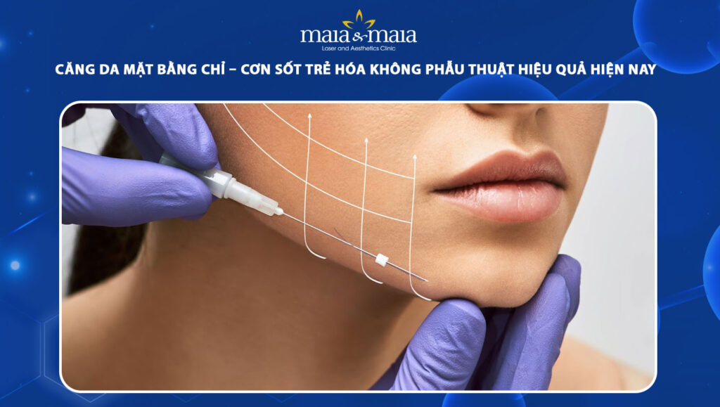 Căng da mặt bằng chỉ: Giải pháp trẻ hóa không phẫu thuật 1 căng da mặt bằng chỉ