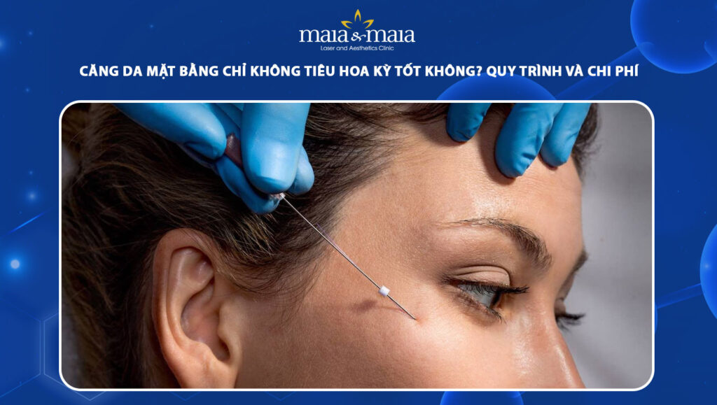 căng da mặt bằng chỉ không tiêu Hoa Kỳ