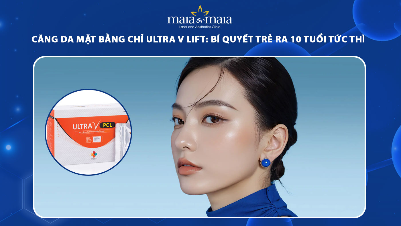 căng da mặt bằng chỉ ultra v lift
