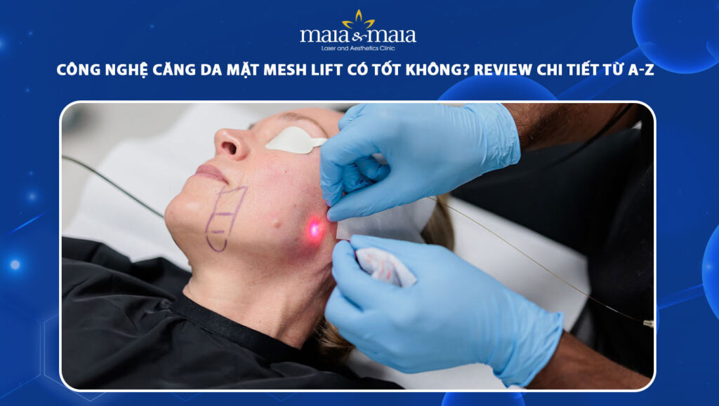 Công nghệ căng da mặt Mesh Lift có tốt không? Review từ A-Z 1 căng da mặt mesh lift