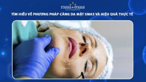 căng da mặt smas