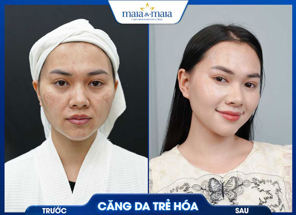 Căng da mặt bằng chỉ: Giải pháp trẻ hóa không phẫu thuật 9 căng da trẻ hóa thành công tại maia