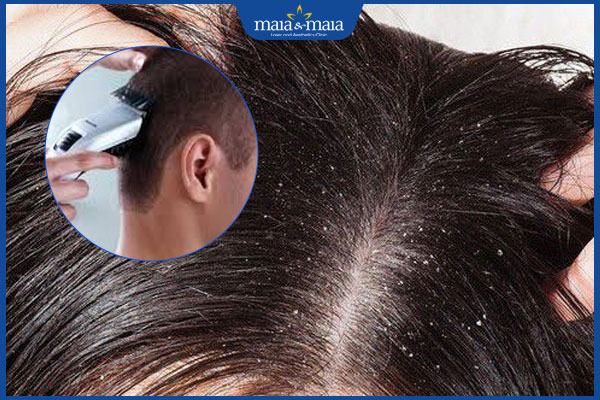 cạo tóc trị trứng tóc
