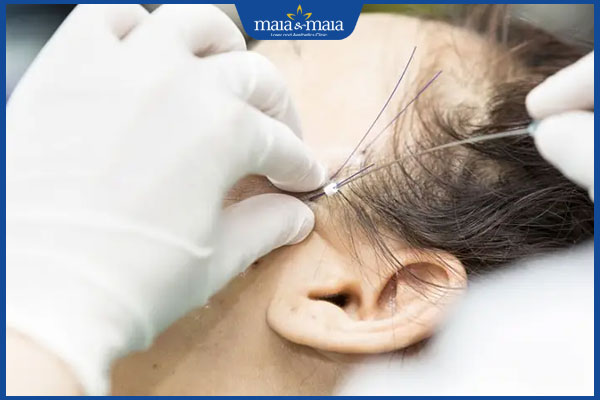 chi phí căng da mặt bằng chỉ