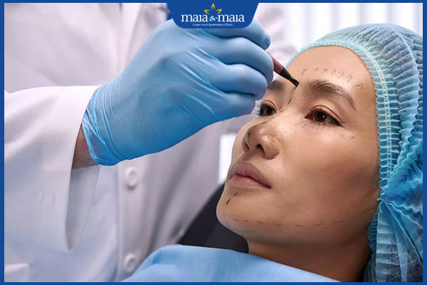 chuẩn bị căng chỉ