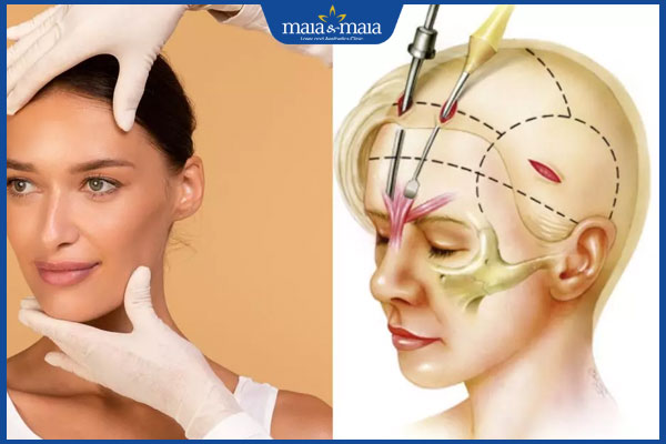 cơ chế căng da mặt nội soi