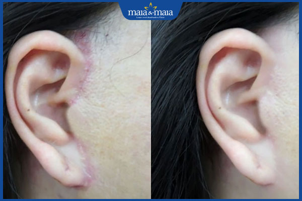 Biến chứng căng da mặt: Rủi ro cần biết trước khi thực hiện 4 cơ địa bị sẹo