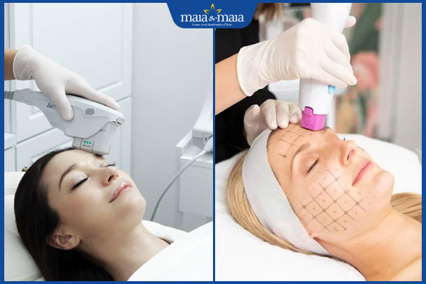 So sánh Ultherapy và Thermage công nghệ nào tốt hơn? 2 công nghệ trẻ hóa