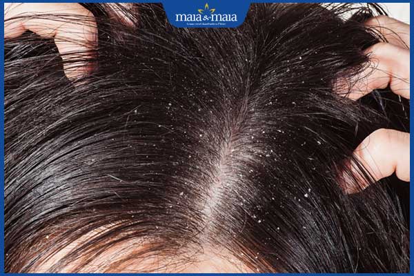 da đầu quá bẩn