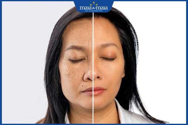 So sánh Ultherapy và Thermage công nghệ nào tốt hơn? 3 da lão hóa nhẹ