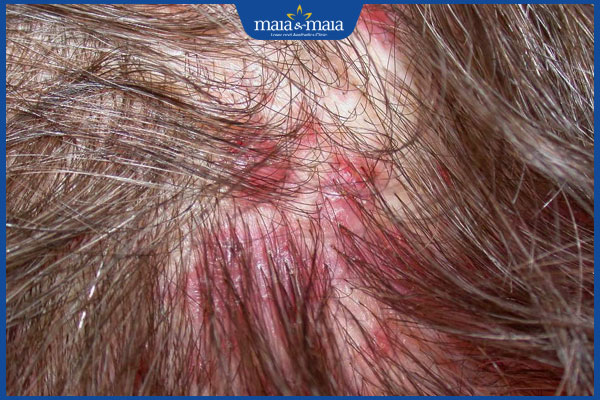 đặc điểm viêm chân tóc