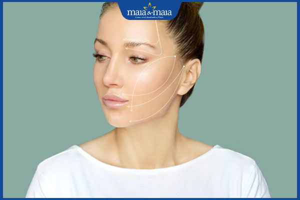 Căng da mặt bằng chỉ: Giải pháp trẻ hóa không phẫu thuật 3 hiệu quả nâng cơ