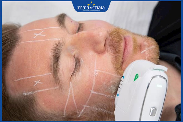 hifu trẻ hóa da nam