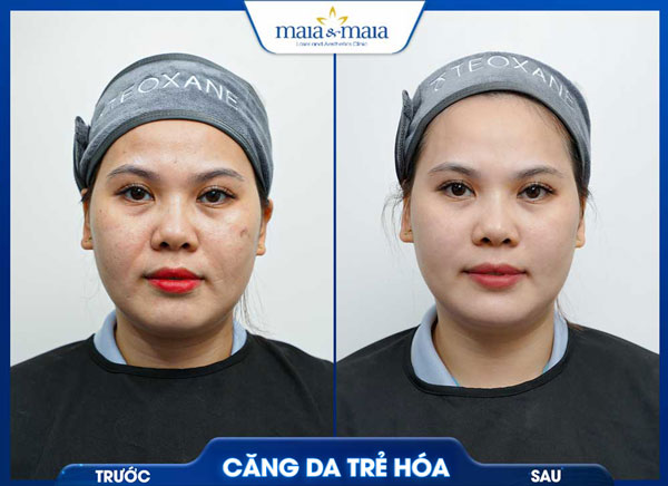 Căng da mặt bằng chỉ: Giải pháp trẻ hóa không phẫu thuật 8 khách hàng căng da trẻ hóa tại maia