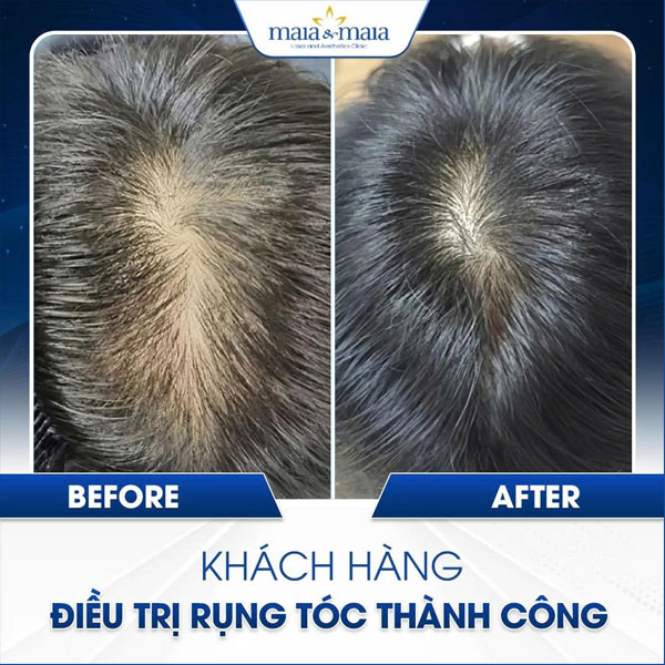 khách hàng điều trị bằng maitrix hair