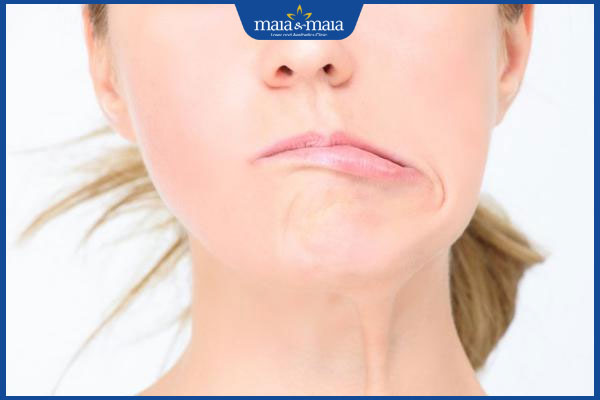 Biến chứng căng da mặt: Rủi ro cần biết trước khi thực hiện 3 liệt cơ mặt