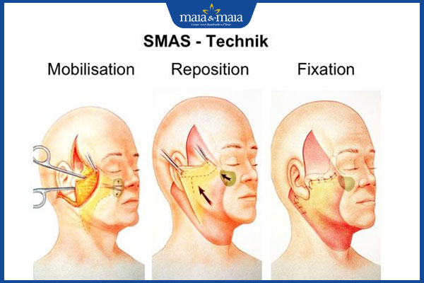 Tìm hiểu về phương pháp căng da mặt SMAS và hiệu quả thực tế 2 mô phỏng căng da mặt smas