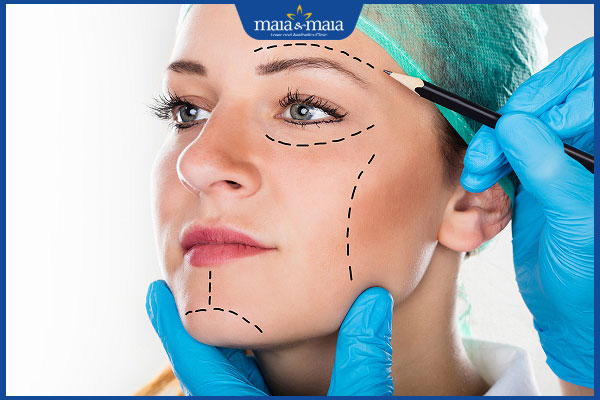 Quy trình, chi phí và địa chỉ thực hiện căng da mặt uy tín 2 phẫu thuật căng da mặt