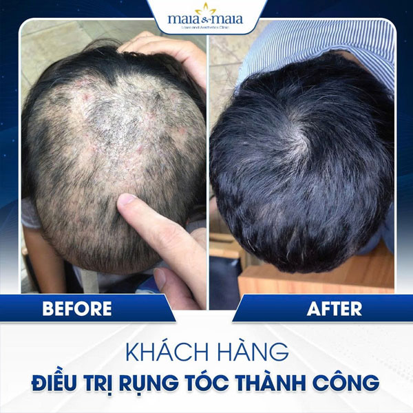 phục hồi mật độ tóc tại maia