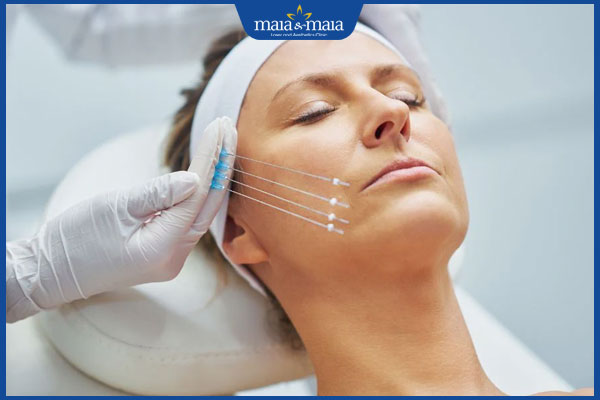 Căng da mặt bằng chỉ: Giải pháp trẻ hóa không phẫu thuật 2 phương pháp căng chỉ da mặt