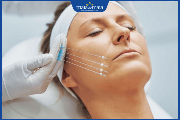 phương pháp căng da mặt bằng chỉ