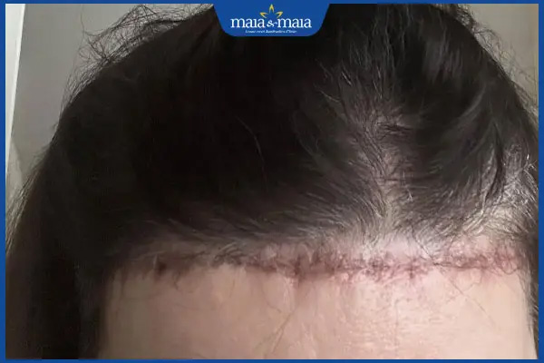 sẹo ở chân tóc
