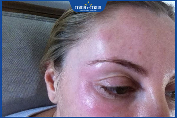 sưng bầm sau tiêm botox