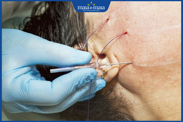 thực hiện căng chỉ da mặt