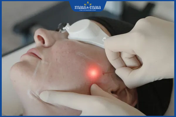 Bao nhiêu tuổi thì nên căng da mặt? Đừng làm khi chưa biết 2 thực hiện căng da mặt