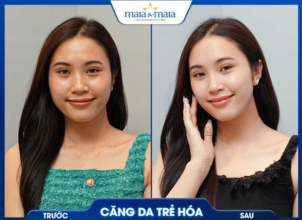 Căng da mặt bằng chỉ: Giải pháp trẻ hóa không phẫu thuật 11 trẻ hóa làn da tại maia