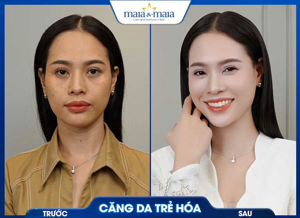 Căng da mặt bằng chỉ: Giải pháp trẻ hóa không phẫu thuật 10 trẻ hóa làn da thành công tại maia