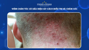 viêm chân tóc