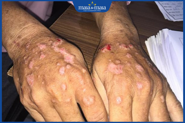 ảnh hưởng của nấm sâu