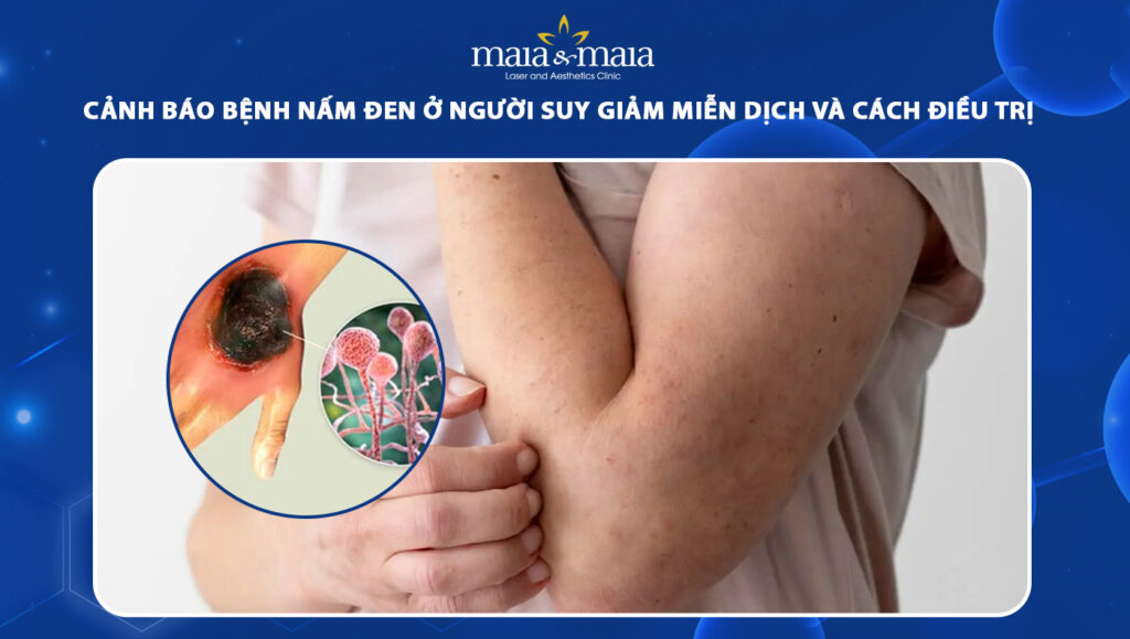 bệnh nấm đen