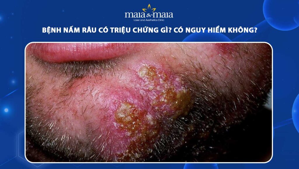 bệnh nấm râu