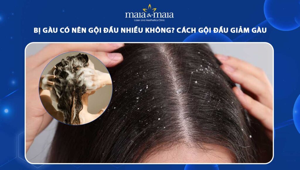 bị gàu có nên gội đầu nhiều