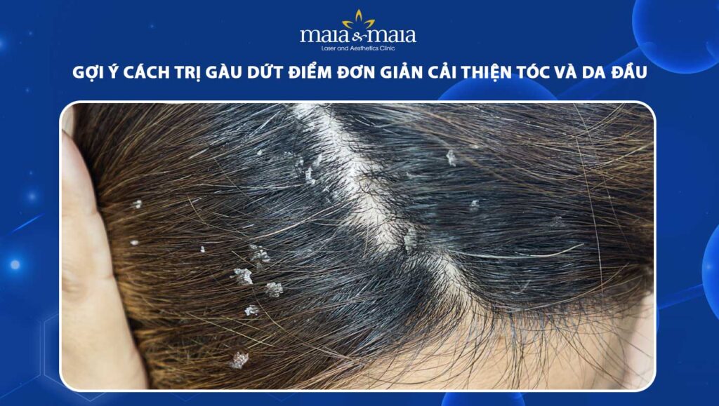 cách trị gàu dứt điểm