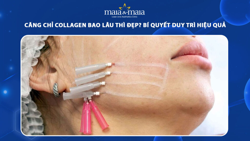 căng chỉ collagen bao lâu thì đẹp