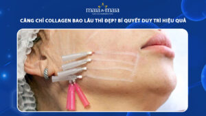 căng chỉ collagen bao lâu thì đẹp