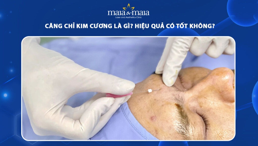 Căng chỉ kim cương có tốt không? Ưu điểm và hạn chế cần biết 1 căng chỉ kim cương