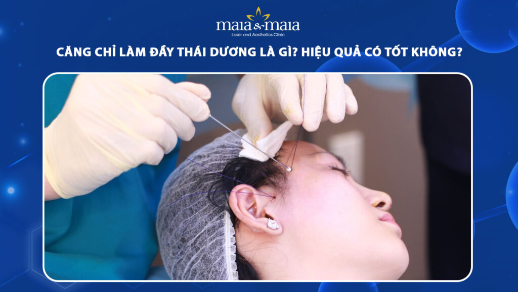 Căng chỉ làm đầy thái dương là gì? Hiệu quả có tốt không? 1 căng chỉ làm đầy thái dương