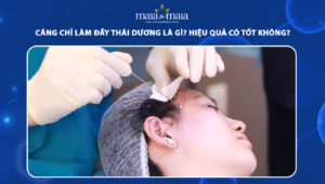 căng chỉ làm đầy thái dương