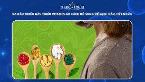da đầu nhiều gàu thiếu vitamin gì