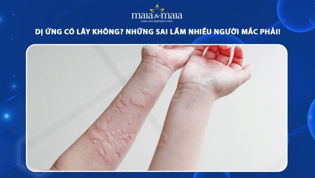 dị ứng có lây không
