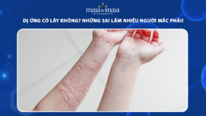 dị ứng có lây không