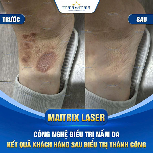 feedback nấm da bàn chân